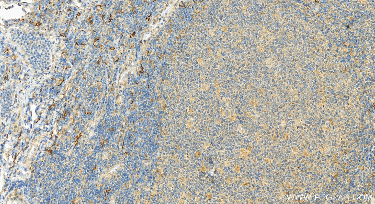 Immunohistochemistry (IHC) staining of human tonsillitis tissue using DC-SIGNR/CD299 Polyclonal antibody (22003-1-AP)