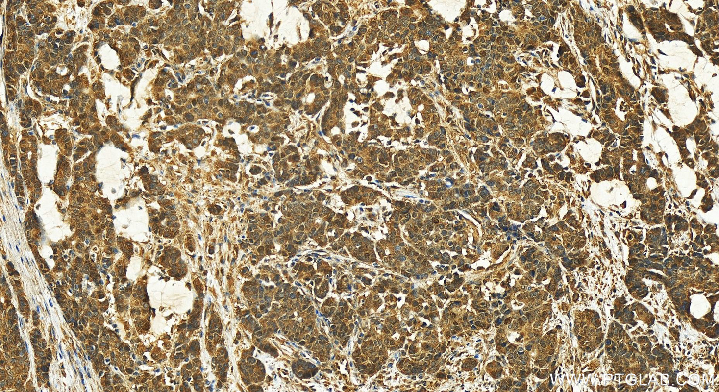 Immunohistochemistry (IHC) staining of human stomach cancer tissue using Claspin Polyclonal antibody (23206-1-AP)