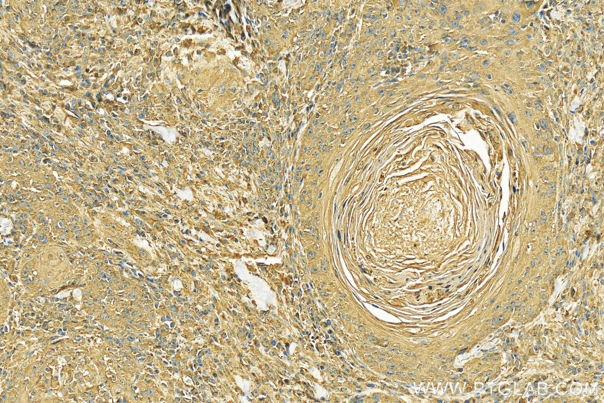 Immunohistochemistry (IHC) staining of human skin cancer tissue using CLTB Polyclonal antibody (10455-1-AP)