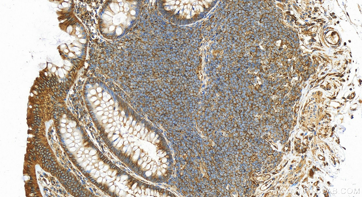 Immunohistochemistry (IHC) staining of human colon tissue using CLTC Polyclonal antibody (26523-1-AP)