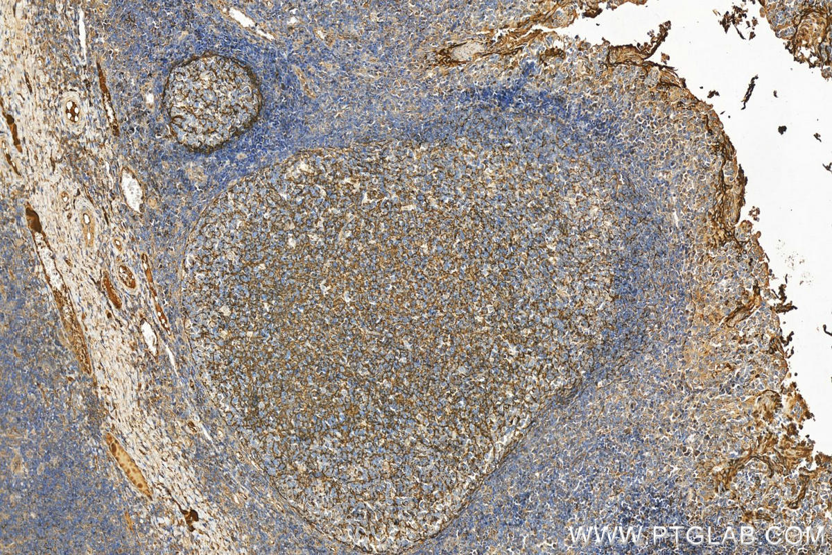 Immunohistochemistry (IHC) staining of human tonsillitis tissue using Clusterin Polyclonal antibody (12289-1-AP)