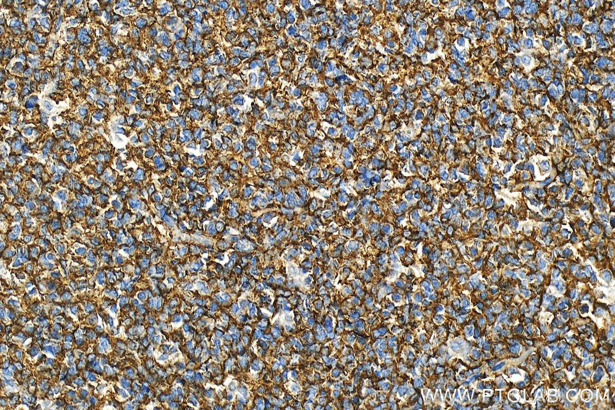 Immunohistochemistry (IHC) staining of human tonsillitis tissue using Clusterin Polyclonal antibody (12289-1-AP)