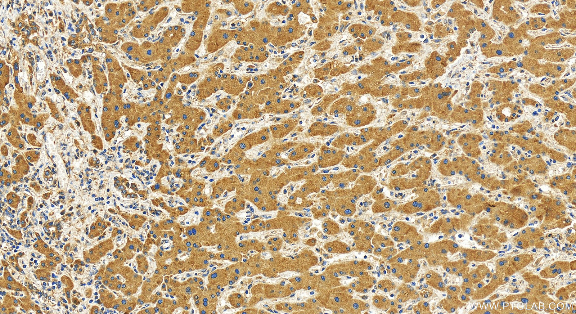 Immunohistochemistry (IHC) staining of human intrahepatic cholangiocarcinoma tissue using CMIP Polyclonal antibody (31407-1-AP)