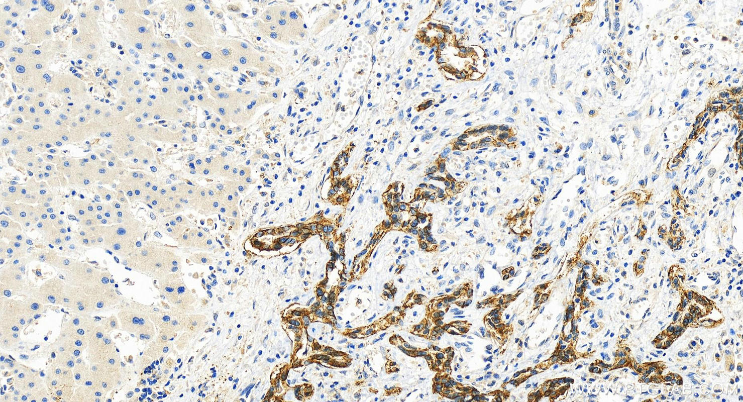 Immunohistochemistry (IHC) staining of human intrahepatic cholangiocarcinoma tissue using CMIP Recombinant antibody (83381-1-RR)