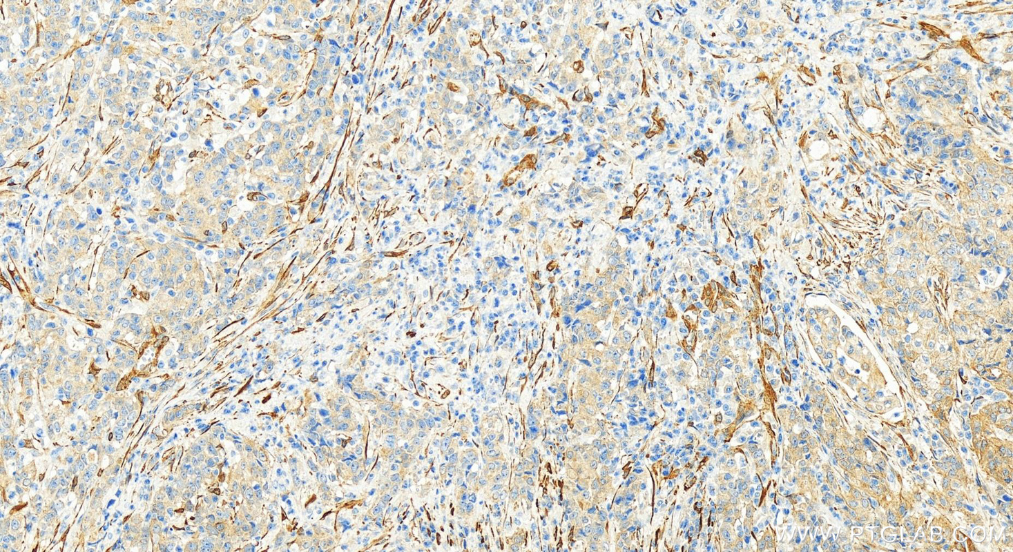 Immunohistochemistry (IHC) staining of human stomach cancer tissue using CNN3 Polyclonal antibody (11509-1-AP)