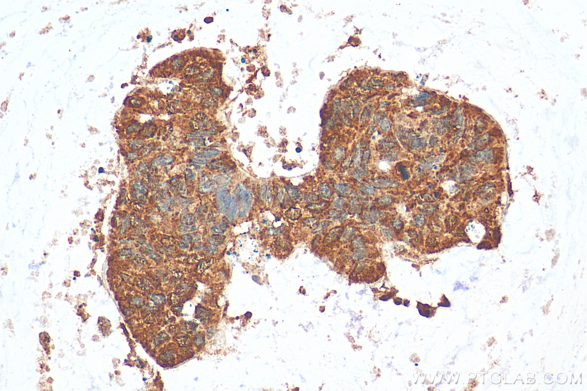 Immunohistochemistry (IHC) staining of human colon cancer tissue using CNOT10 Polyclonal antibody (15938-1-AP)