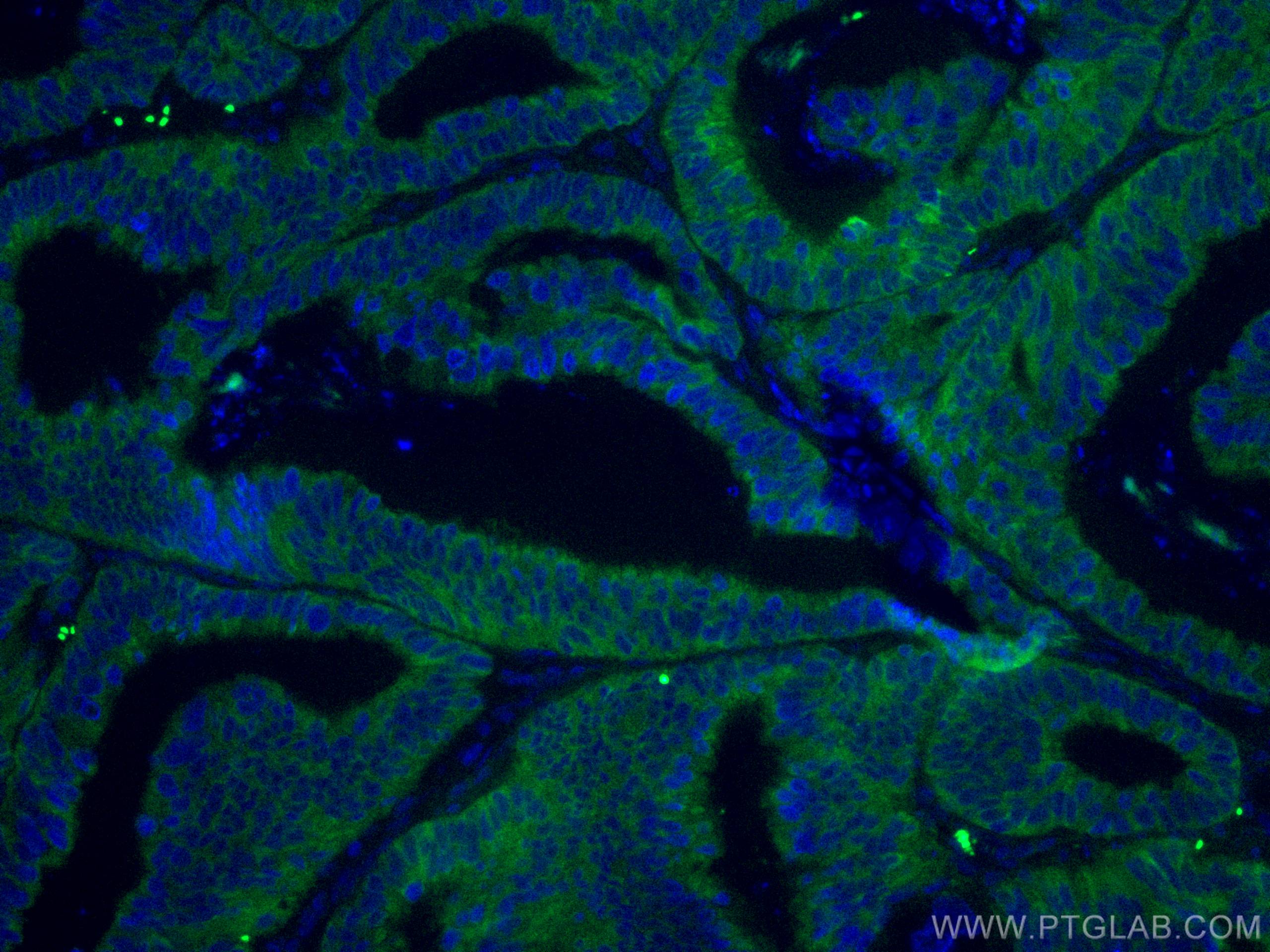 Immunofluorescence (IF) / fluorescent staining of human colon cancer tissue using CoraLite® Plus 488-conjugated CNOT4 Monoclonal ant (CL488-67798)