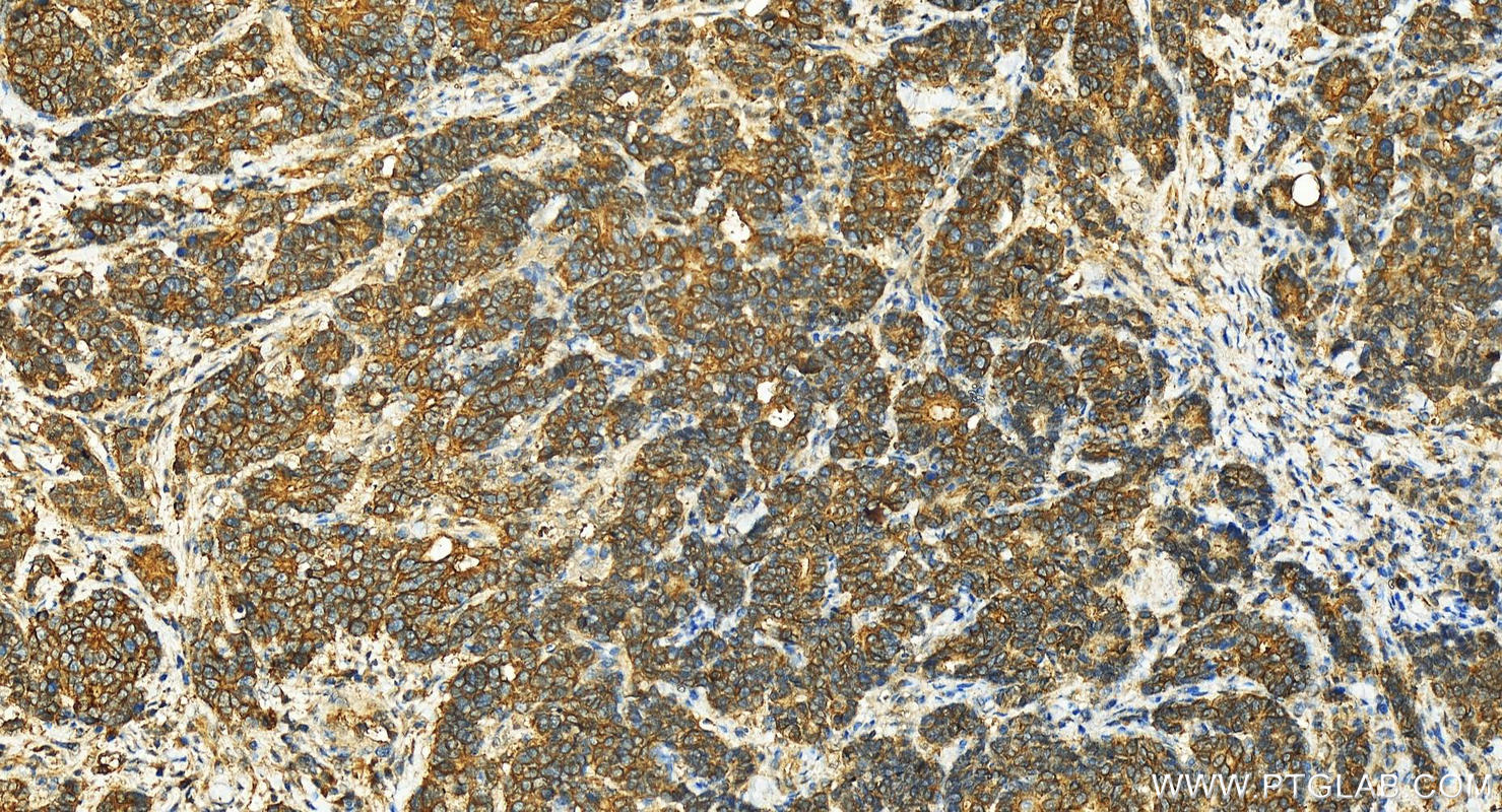 Immunohistochemistry (IHC) staining of human stomach cancer tissue using COG6 Polyclonal antibody (14277-1-AP)