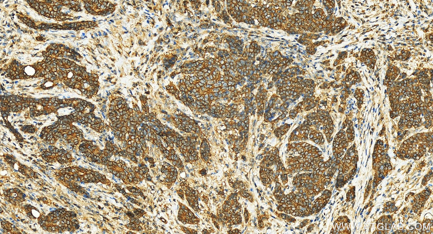 Immunohistochemistry (IHC) staining of human stomach cancer tissue using COG6 Polyclonal antibody (14277-1-AP)