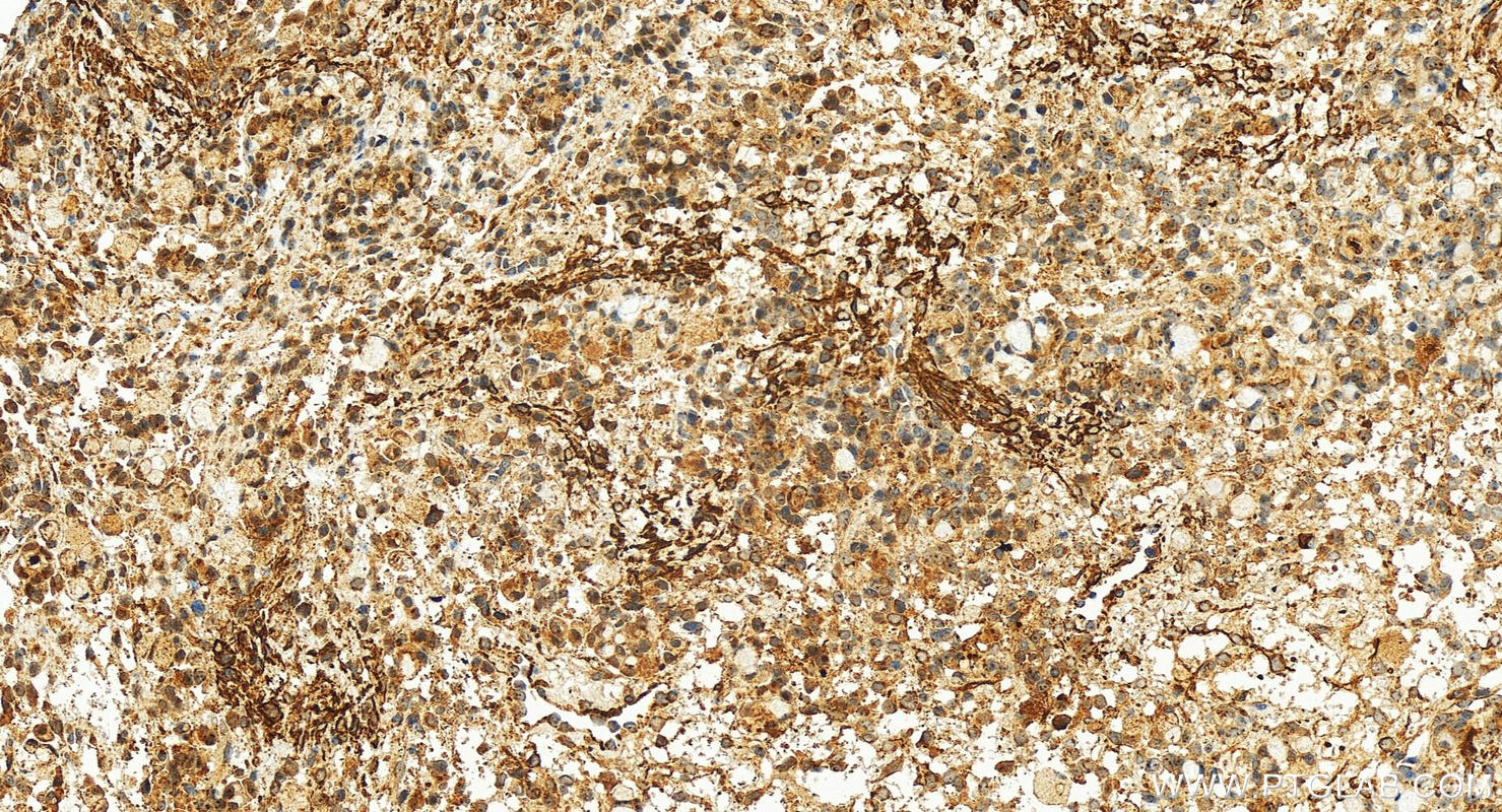 Immunohistochemistry (IHC) staining of human ovary cancer tissue using COG8 Polyclonal antibody (12661-1-AP)