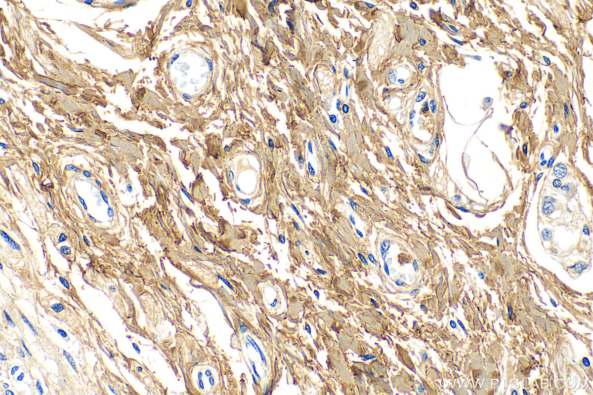 Immunohistochemistry (IHC) staining of human colon tissue using Collagen Type I Polyclonal antibody (14695-1-AP)