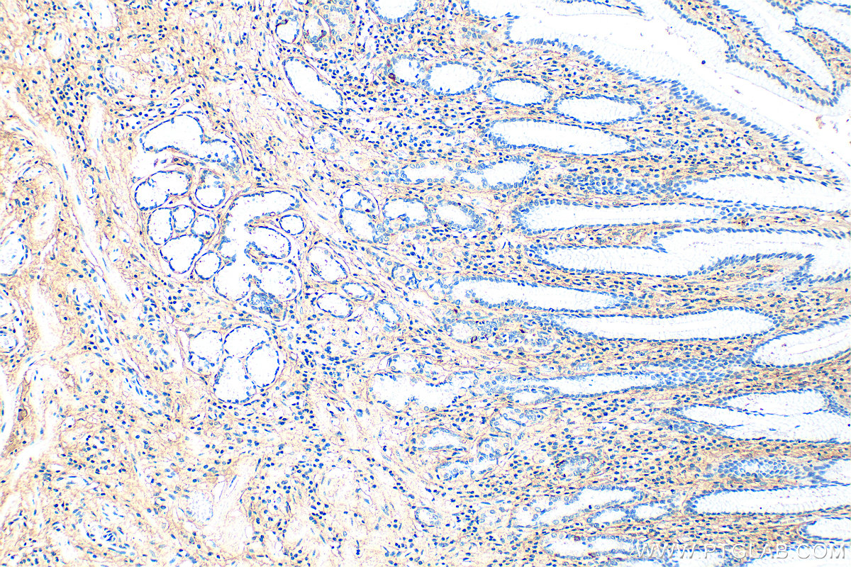 Immunohistochemistry (IHC) staining of human stomach cancer tissue using Collagen Type I Polyclonal antibody (14695-1-AP)