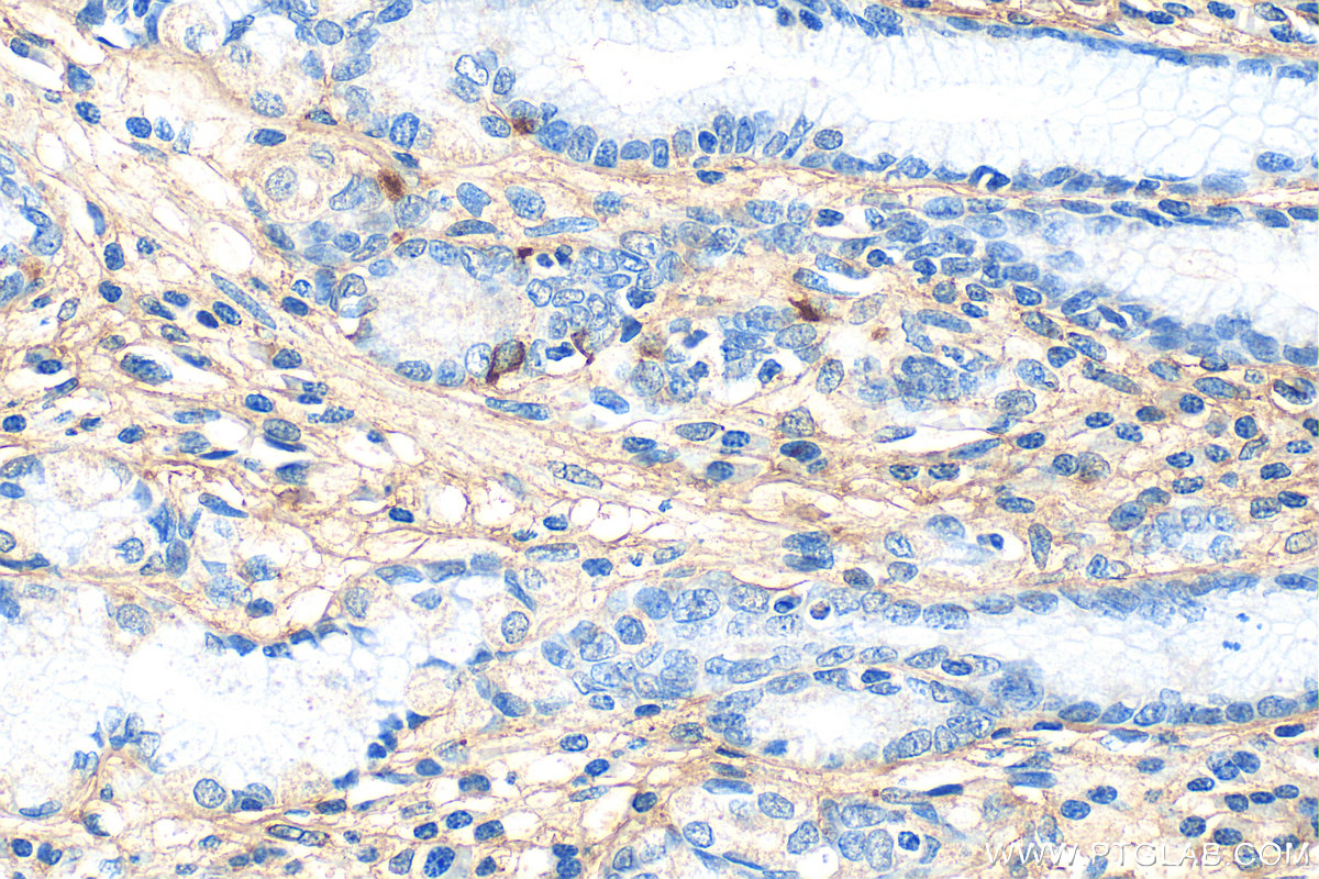 Immunohistochemistry (IHC) staining of human stomach cancer tissue using Collagen Type I Polyclonal antibody (14695-1-AP)