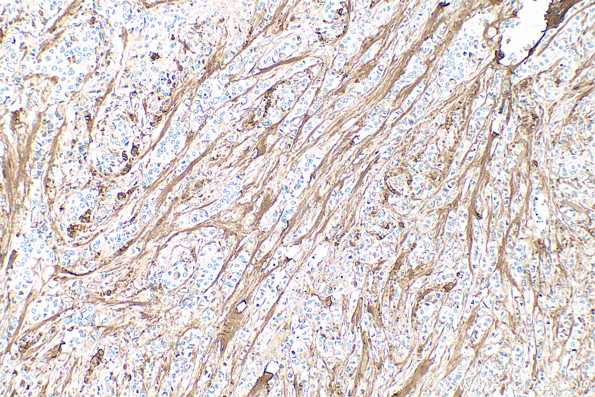 Immunohistochemistry (IHC) staining of human breast cancer tissue using Collagen Type I Polyclonal antibody (14695-1-AP)