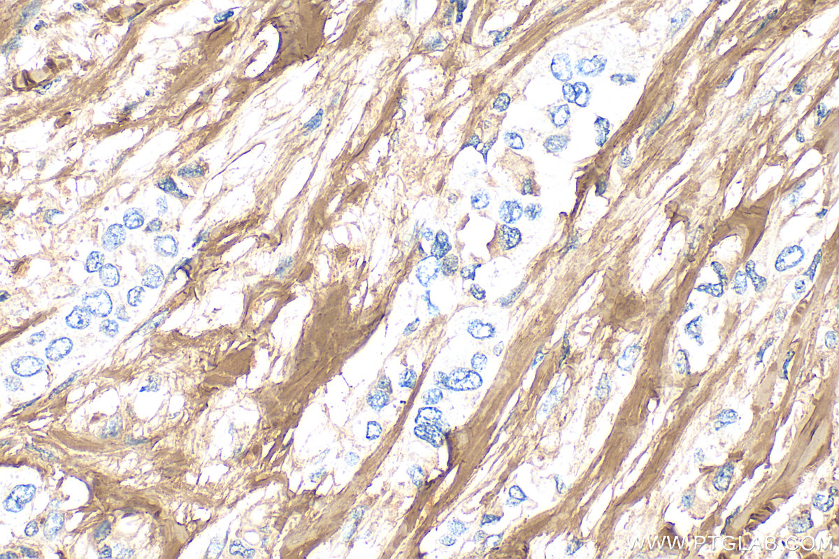 Immunohistochemistry (IHC) staining of human breast cancer tissue using Collagen Type I Polyclonal antibody (14695-1-AP)