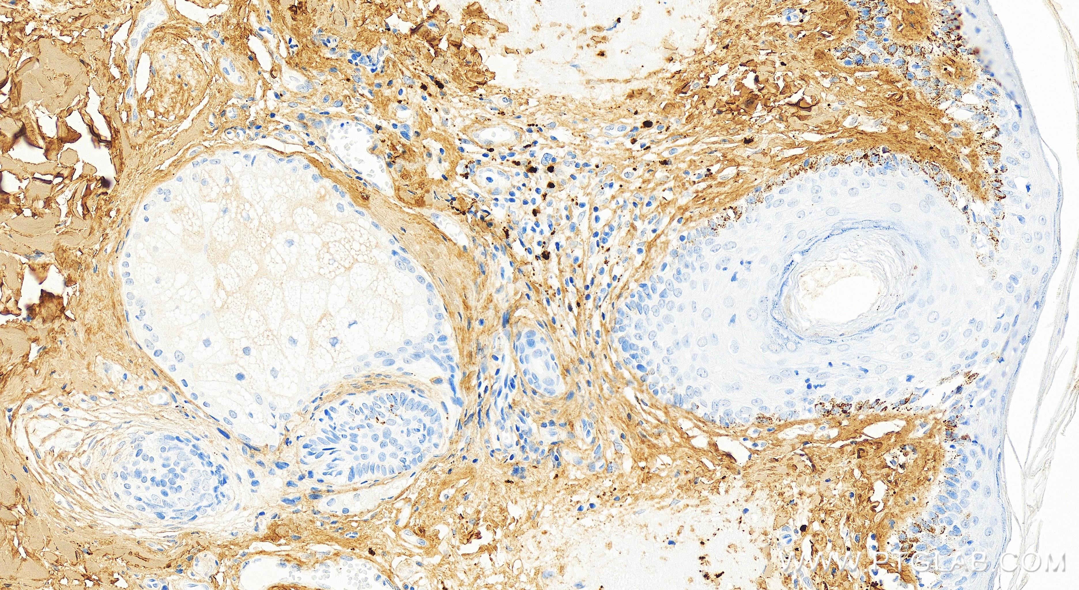 Immunohistochemistry (IHC) staining of human skin tissue using Collagen Type I Recombinant antibody (83752-5-RR)