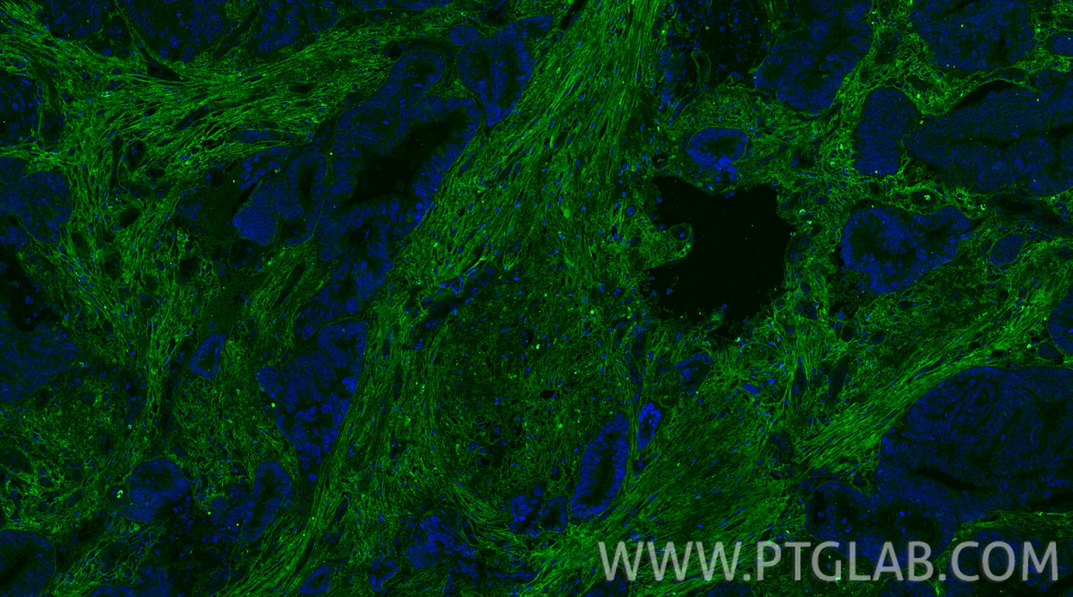 Immunofluorescence (IF) / fluorescent staining of human colon cancer tissue using Collagen Type III Monoclonal antibody (68320-1-Ig)