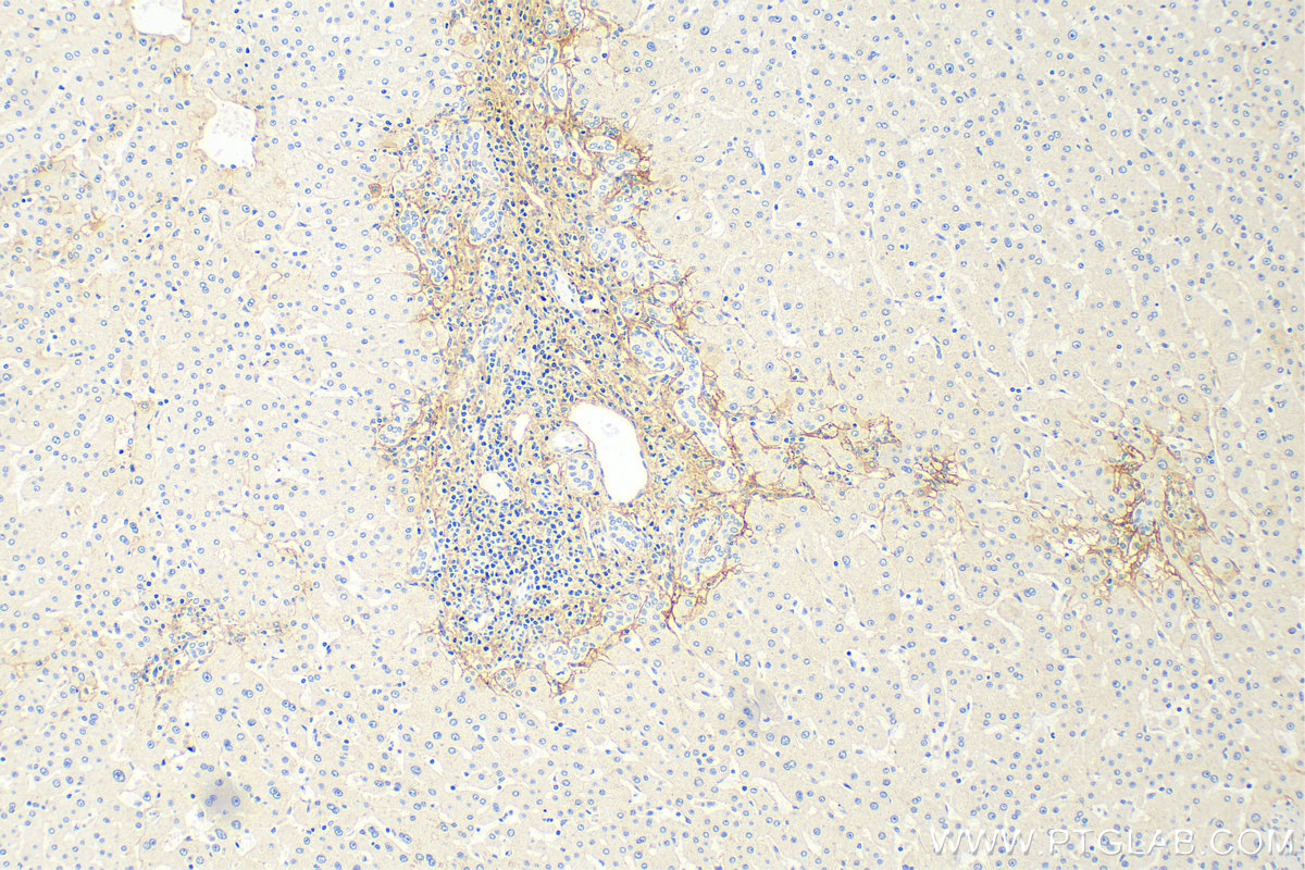 Immunohistochemistry (IHC) staining of human hepatocirrhosis tissue using COL3A1 Monoclonal antibody (68320-1-Ig)