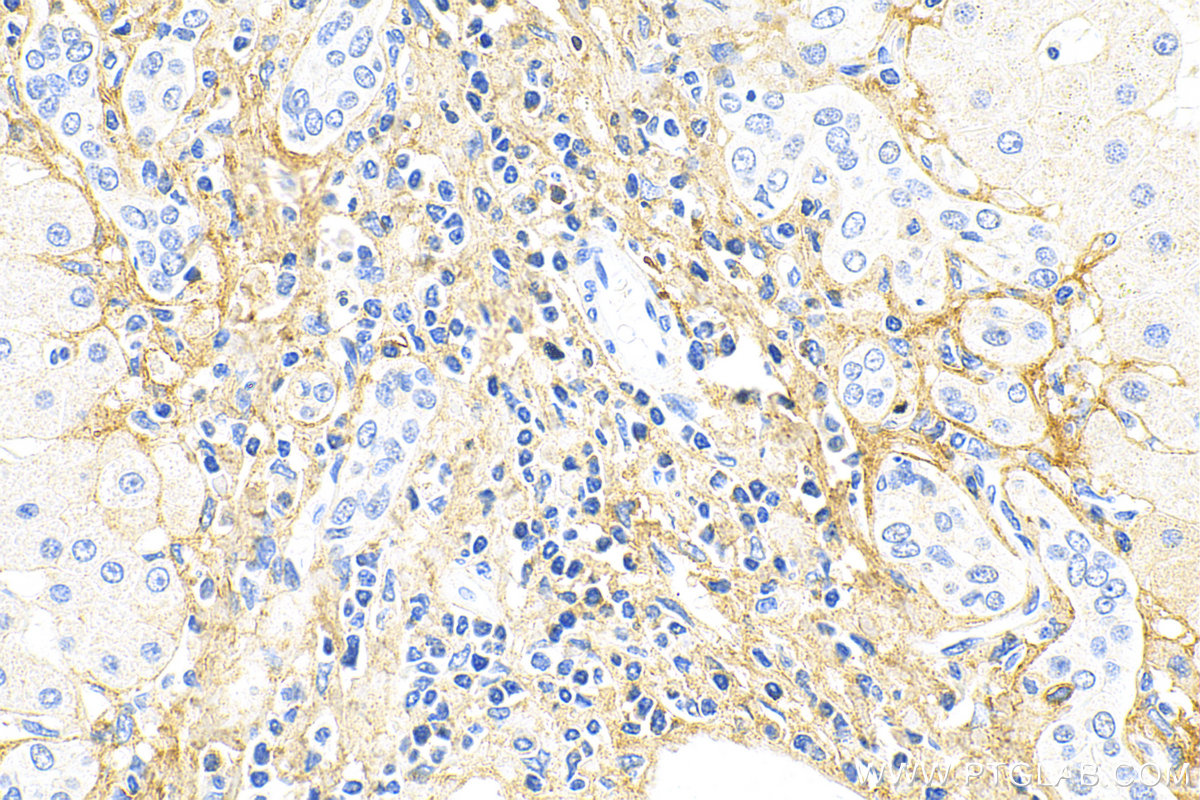 Immunohistochemistry (IHC) staining of human hepatocirrhosis tissue using COL3A1 Monoclonal antibody (68320-1-Ig)