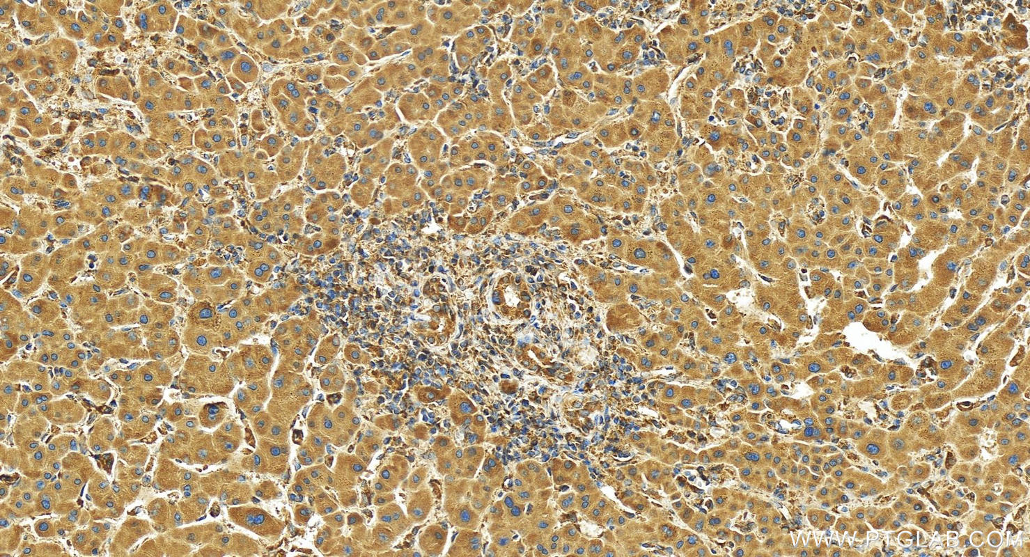 Immunohistochemistry (IHC) staining of human intrahepatic cholangiocarcinoma tissue using COMMD8 Polyclonal antibody (25237-1-AP)