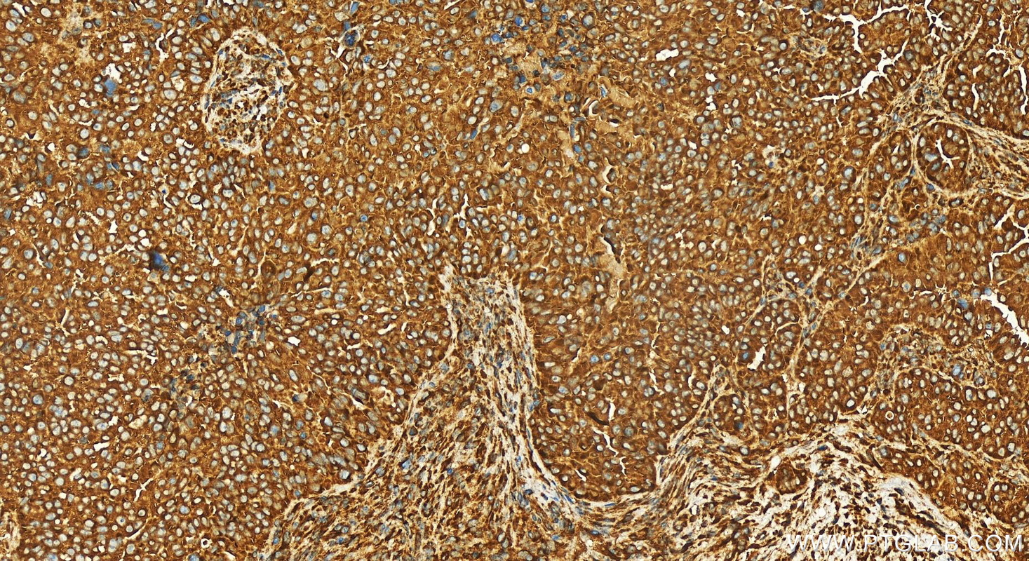 Immunohistochemistry (IHC) staining of human ovarian  cancer using COPA Recombinant antibody (83089-2-RR)