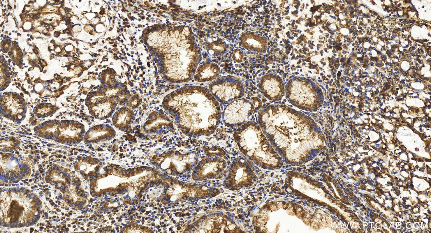 Immunohistochemistry (IHC) staining of human stomach cancer tissue using COPB2 Polyclonal antibody (14733-1-AP)