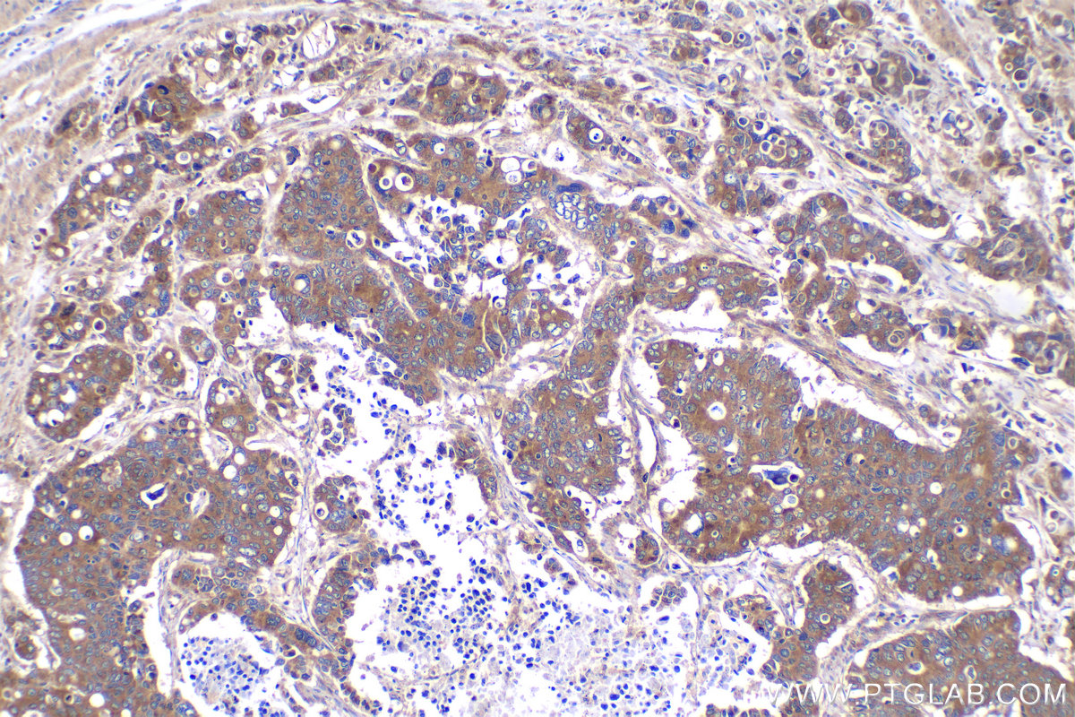 Immunohistochemistry (IHC) staining of human stomach cancer tissue using COPE Polyclonal antibody (11457-1-AP)