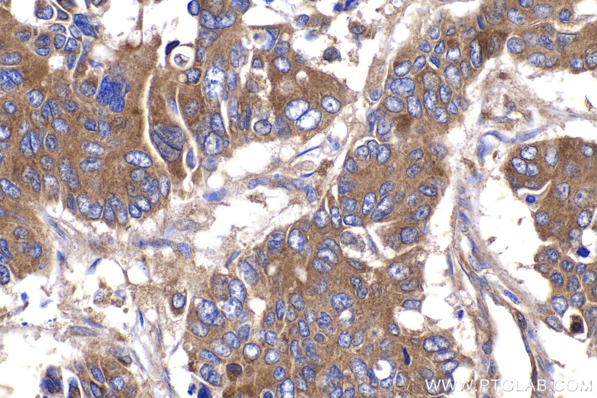 Immunohistochemistry (IHC) staining of human stomach cancer tissue using COPE Polyclonal antibody (11457-1-AP)