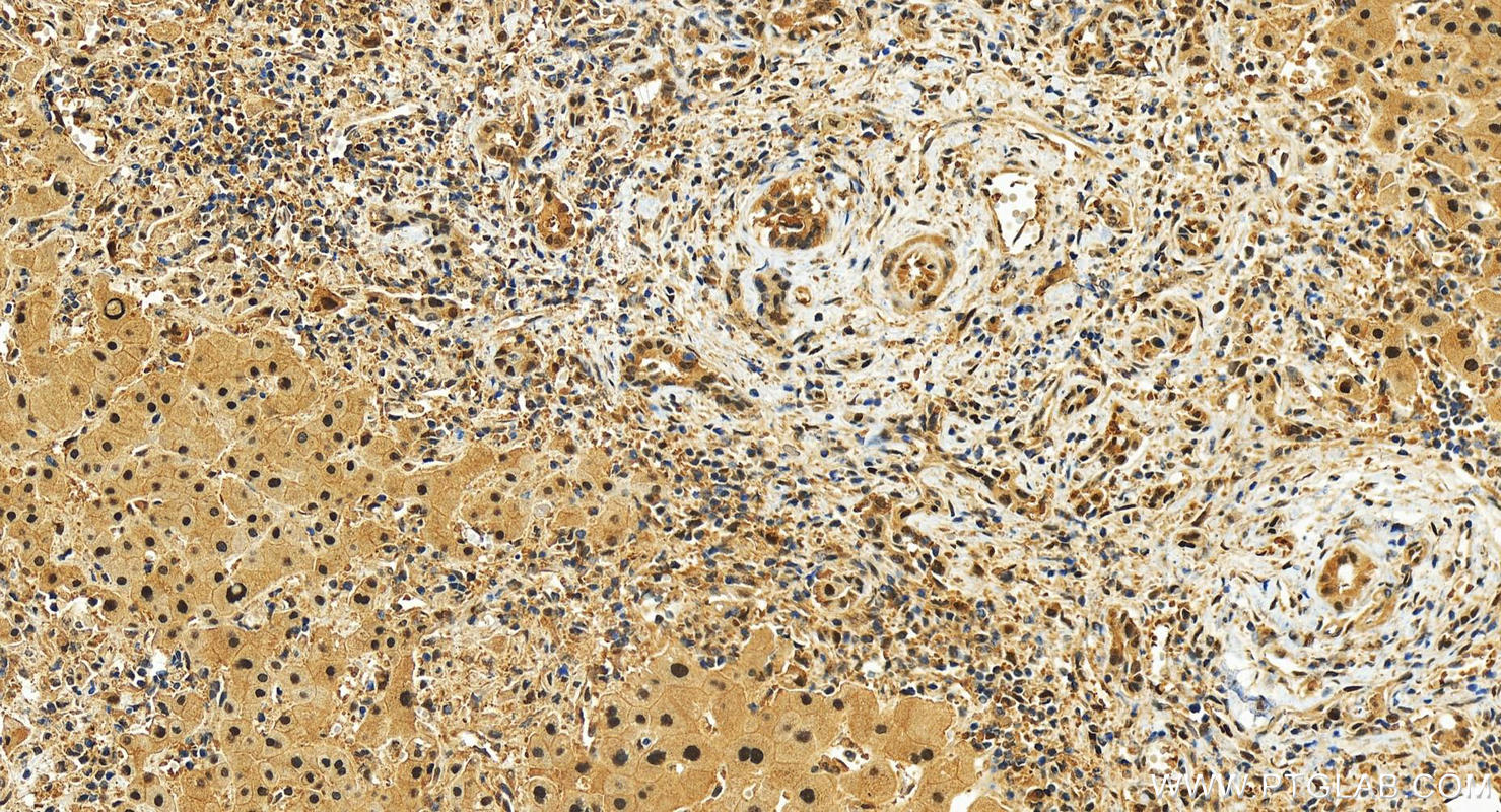 Immunohistochemistry (IHC) staining of human intrahepatic cholangiocarcinoma tissue using COPS3 Polyclonal antibody (30494-1-AP)