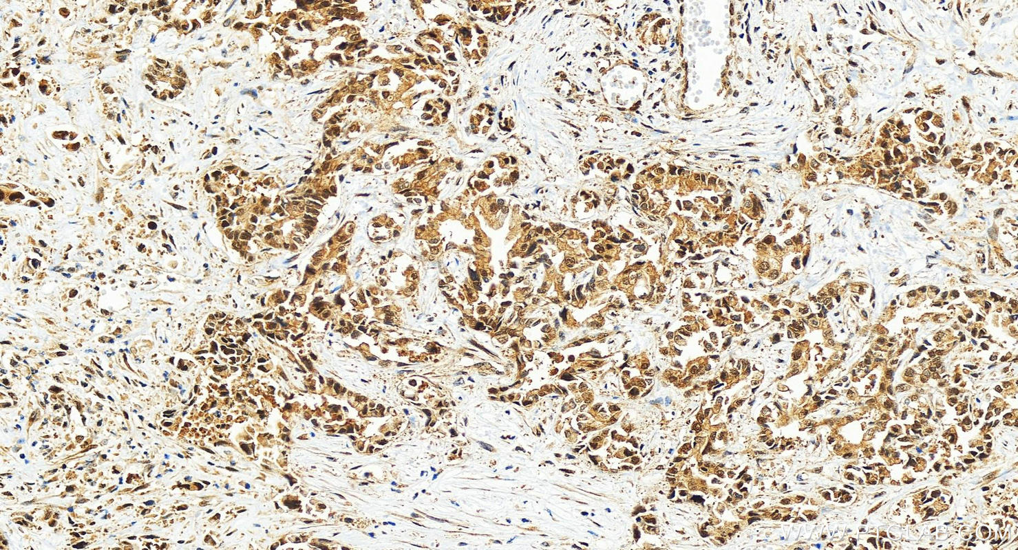 Immunohistochemistry (IHC) staining of human intrahepatic cholangiocarcinoma tissue using COPS8 Recombinant antibody (83312-1-RR)