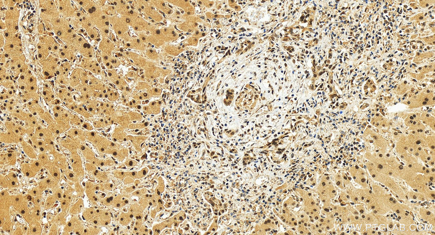 Immunohistochemistry (IHC) staining of human intrahepatic cholangiocarcinoma tissue using COPS8 Recombinant antibody (83312-1-RR)