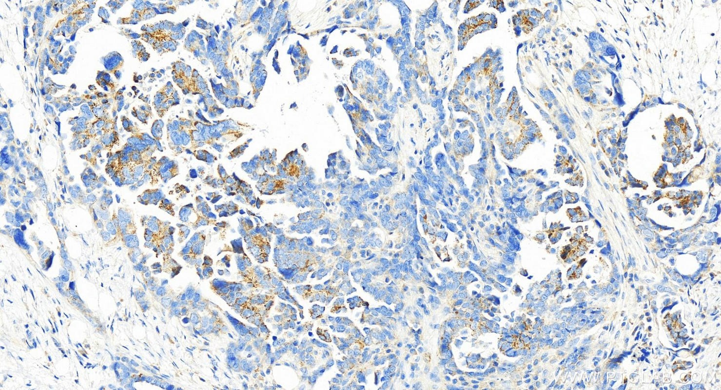 Immunohistochemistry (IHC) staining of human ovary cancer tissue using CORO2B Polyclonal antibody (13802-1-AP)