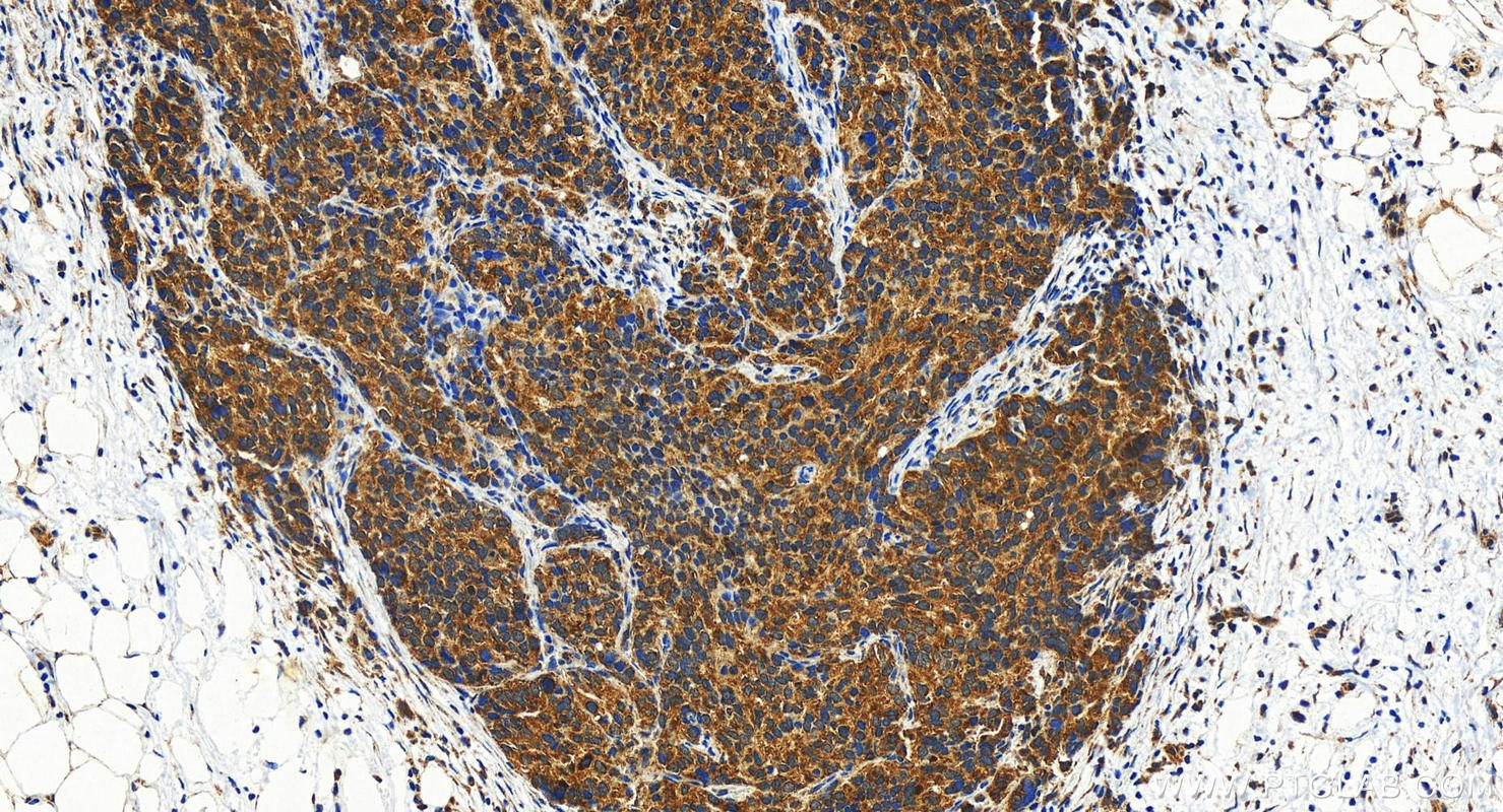 Immunohistochemistry (IHC) staining of human ovary cancer tissue using COX16 Polyclonal antibody (19425-1-AP)