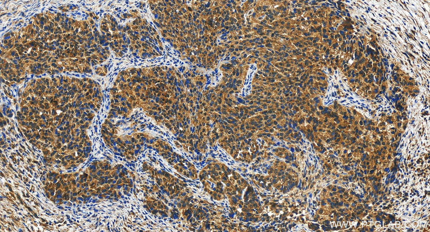 Immunohistochemistry (IHC) staining of human ovary cancer tissue using COX18 Polyclonal antibody (18071-1-AP)