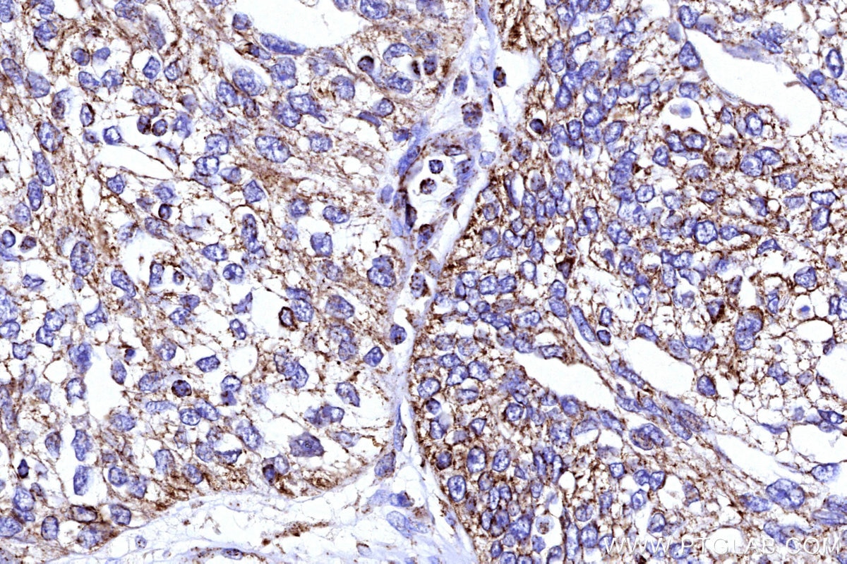 Immunohistochemistry (IHC) staining of human ovary cancer tissue using COX5B Polyclonal antibody (11418-2-AP)