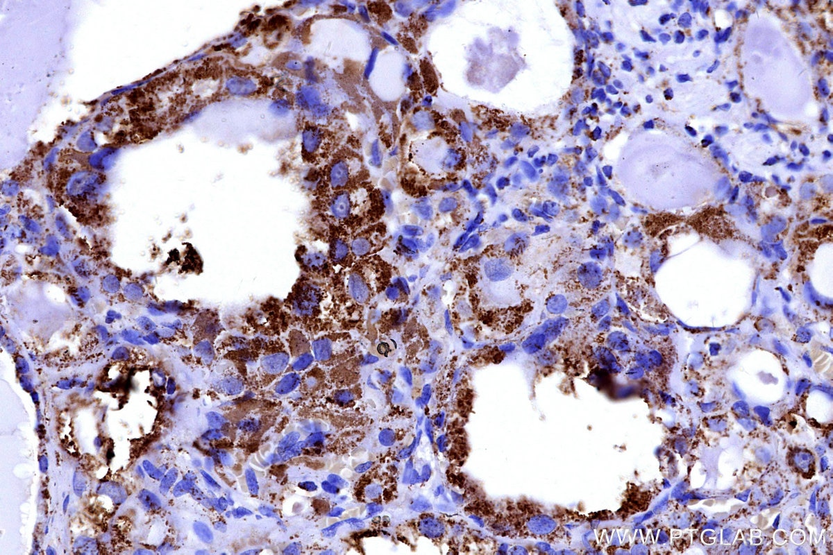 Immunohistochemistry (IHC) staining of human thyroid cancer tissue using COX5B Polyclonal antibody (11418-2-AP)