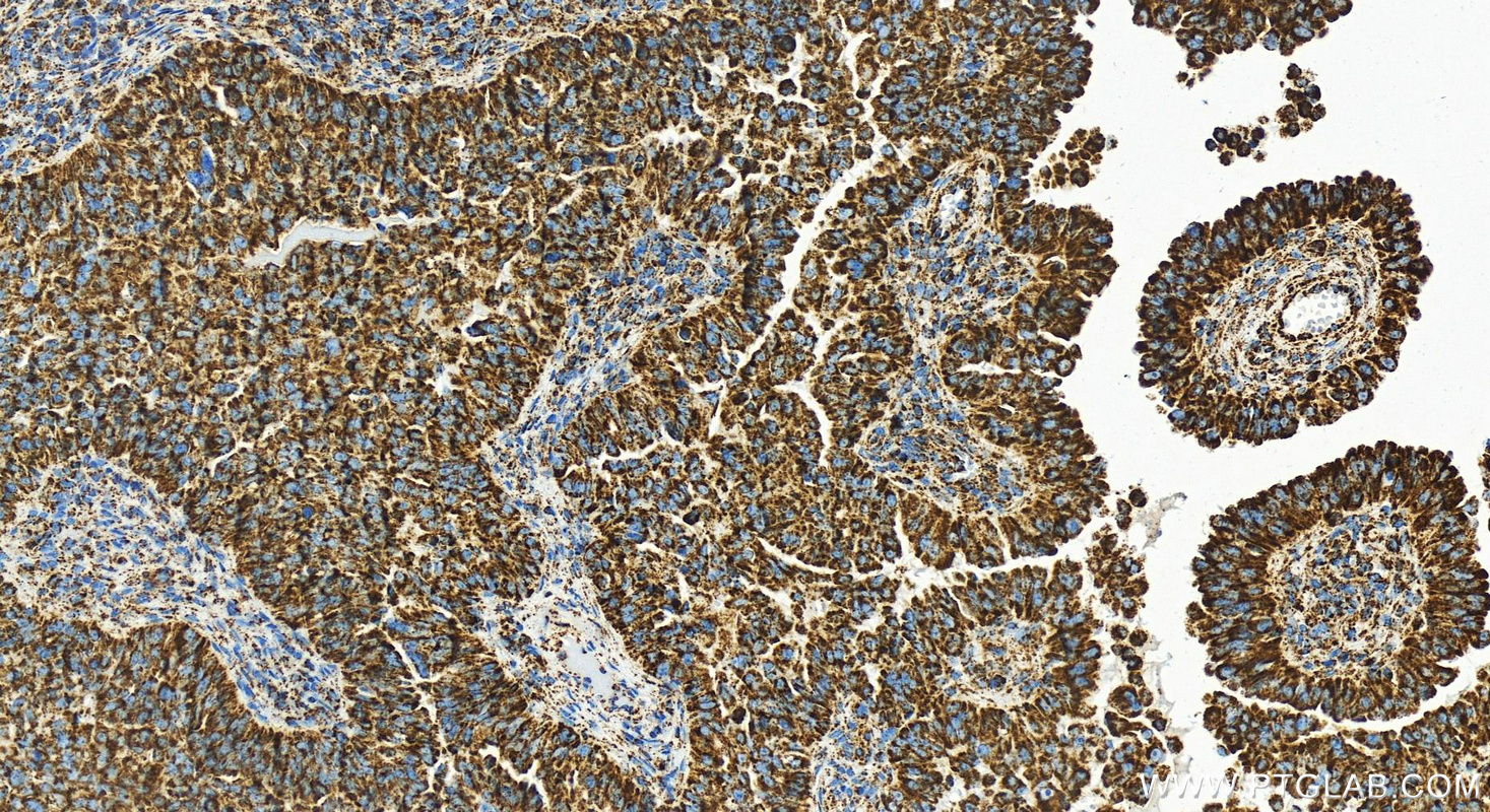 Immunohistochemistry (IHC) staining of human ovarian  cancer using COXIV Recombinant antibody (82916-1-RR)