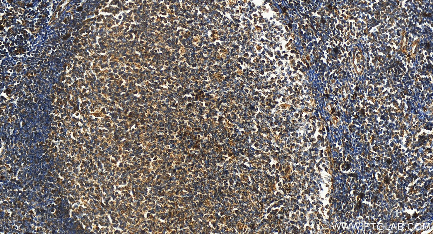 Immunohistochemistry (IHC) staining of human tonsillitis tissue using Carboxypeptidase A3 Polyclonal antibody (16236-1-AP)