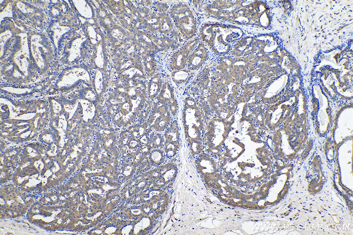 Immunohistochemistry (IHC) staining of human breast cancer tissue using CPNE1 Polyclonal antibody (10126-2-AP)