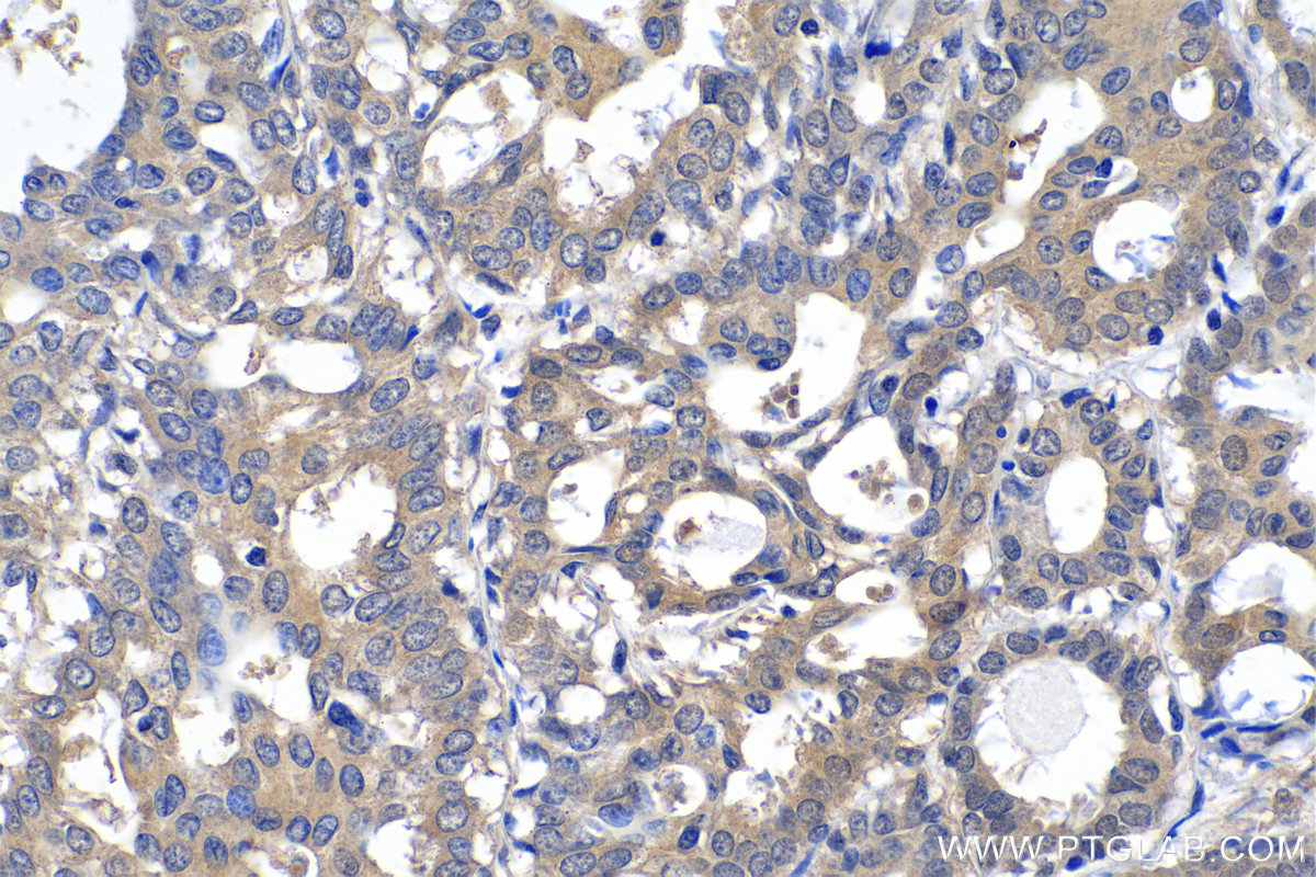 Immunohistochemistry (IHC) staining of human breast cancer tissue using CPNE1 Polyclonal antibody (10126-2-AP)