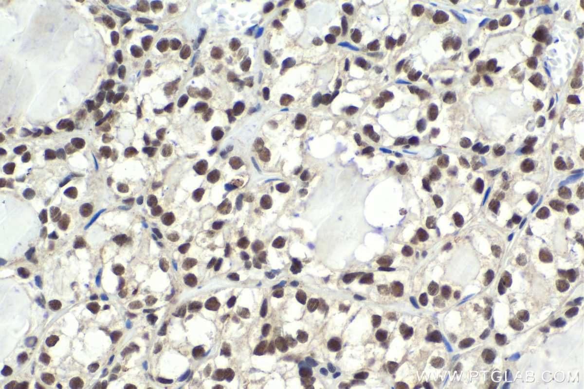Immunohistochemistry (IHC) staining of human thyroid cancer tissue using CPSF3 Polyclonal antibody (11609-1-AP)
