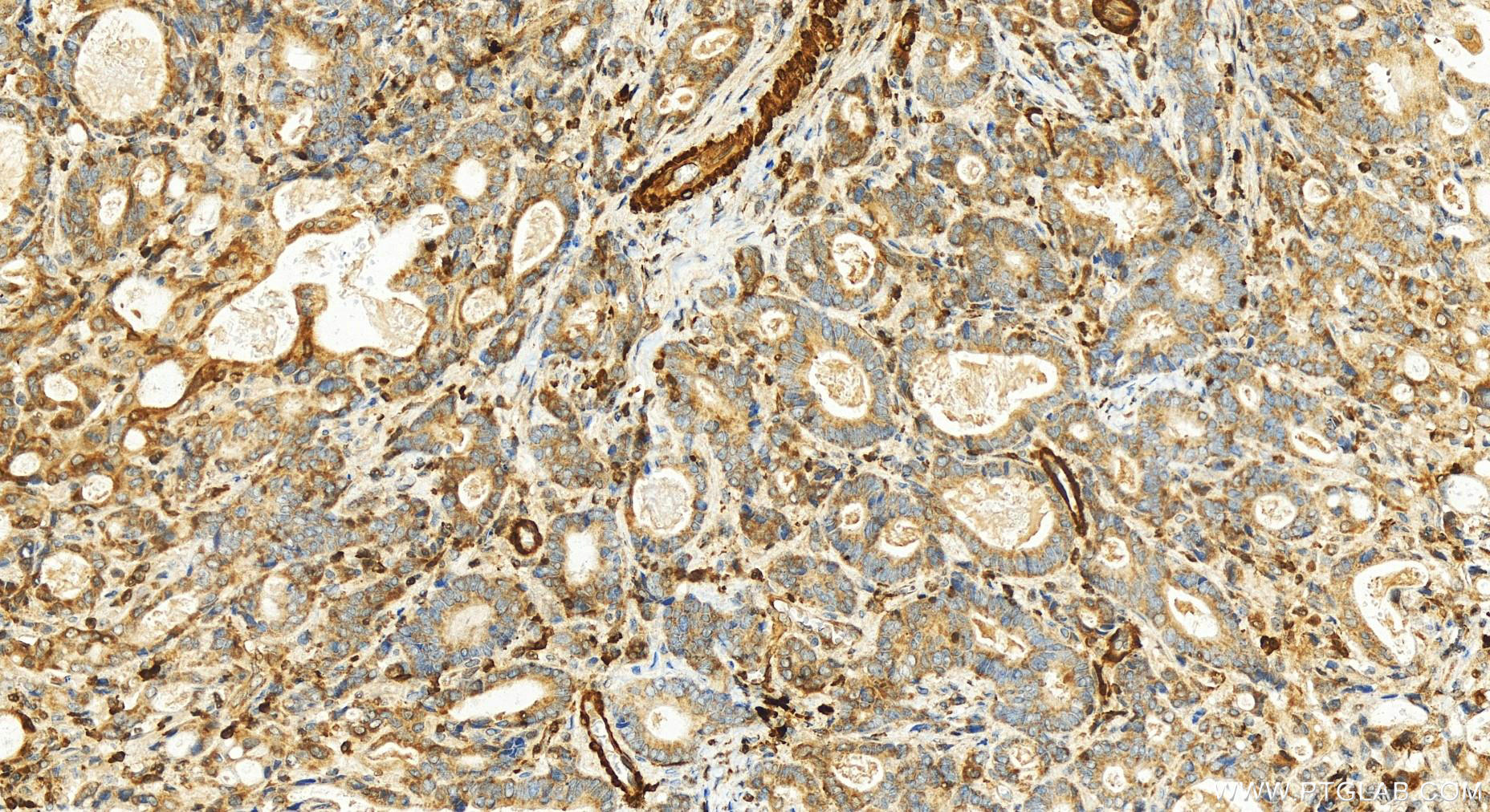 Immunohistochemistry (IHC) staining of human stomach cancer tissue using CRIP1 Polyclonal antibody (15349-1-AP)