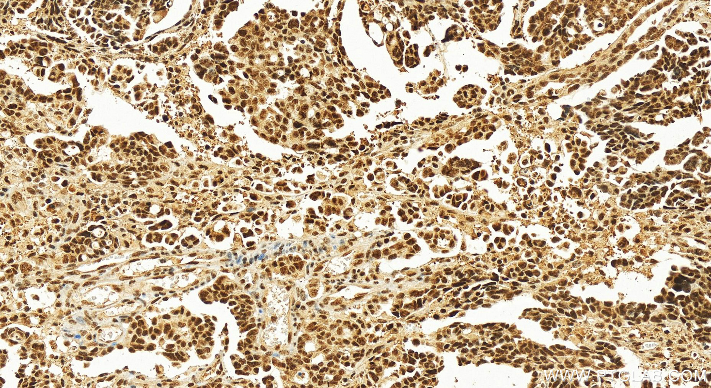 Immunohistochemistry (IHC) staining of human ovary cancer tissue using CROP Polyclonal antibody (14504-1-AP)