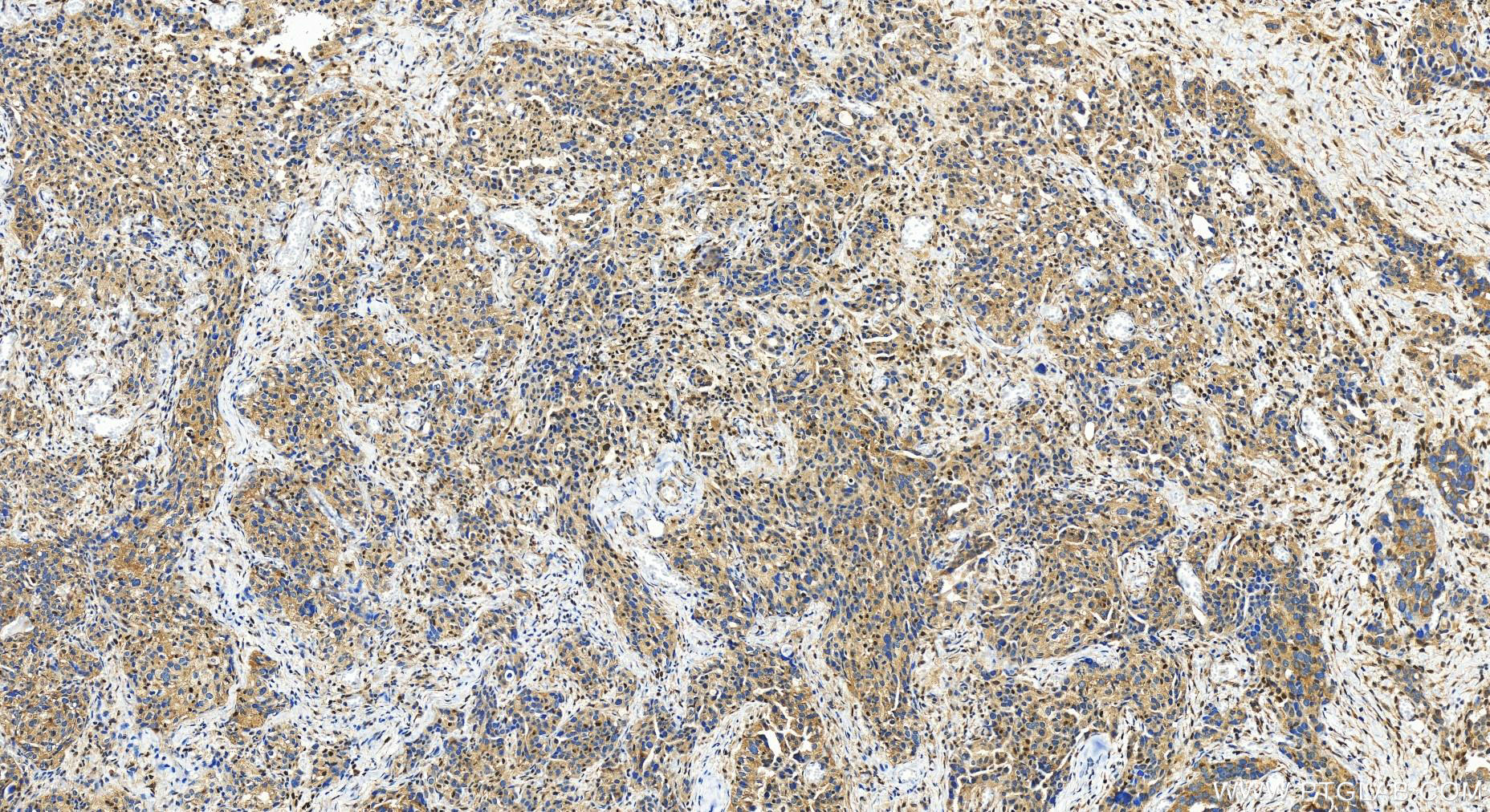 Immunohistochemistry (IHC) staining of human ovary cancer tissue using CRTC1 Polyclonal antibody (27647-1-AP)