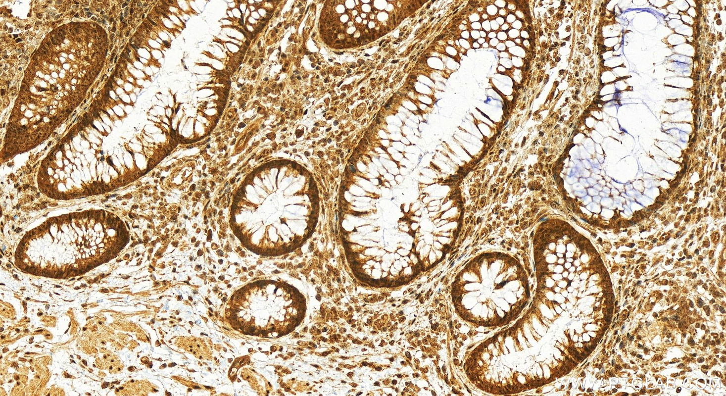 Immunohistochemistry (IHC) staining of human colon cancer tissue using CSNK2A1 Polyclonal antibody (10992-1-AP)