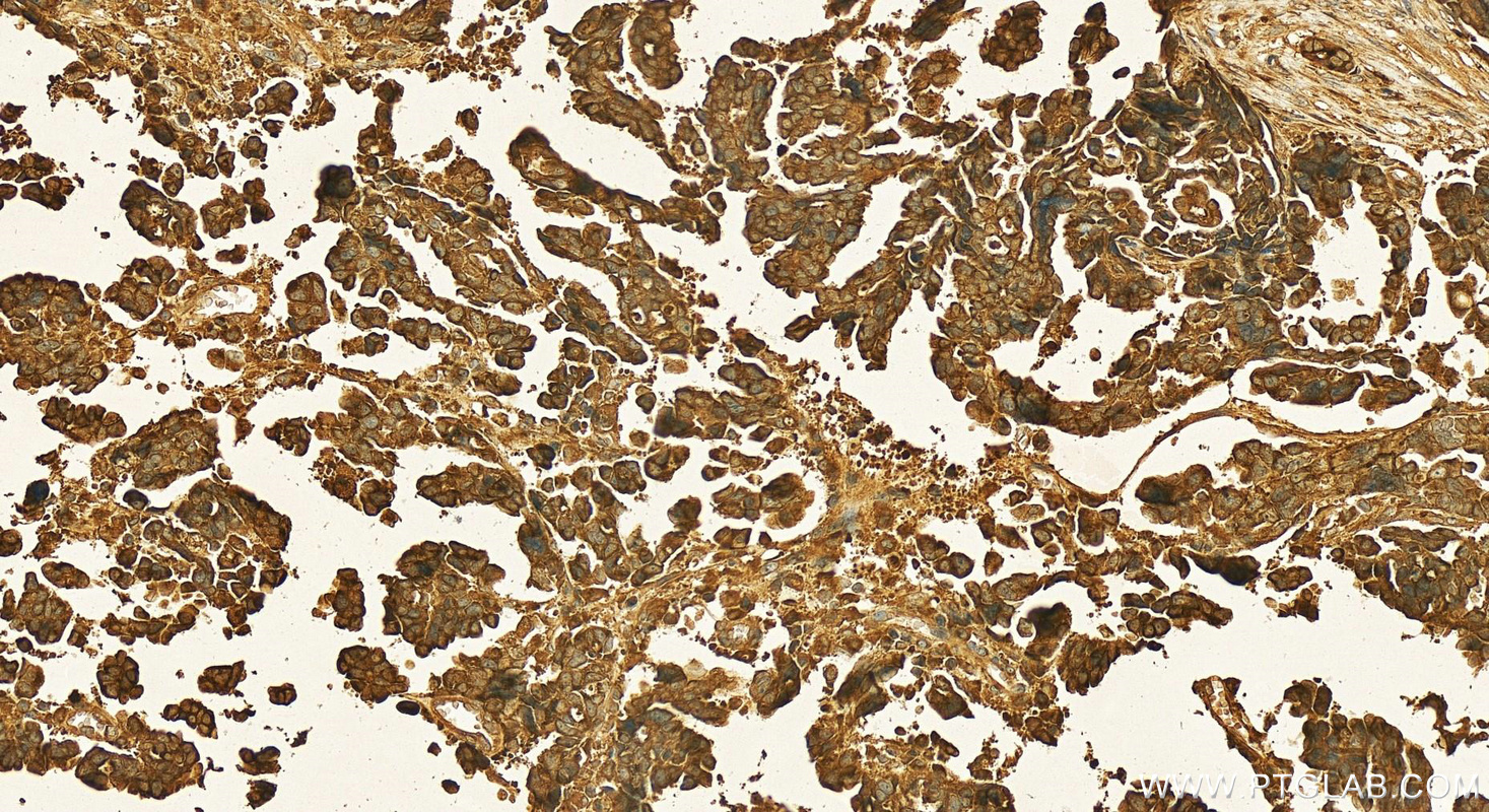 Immunohistochemistry (IHC) staining of human ovary cancer tissue using Cystatin C Polyclonal antibody (12245-1-AP)