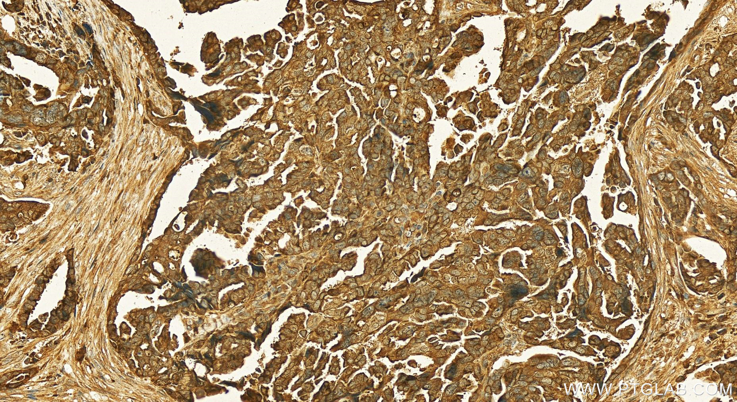 Immunohistochemistry (IHC) staining of human ovary cancer tissue using Cystatin C Polyclonal antibody (12245-1-AP)