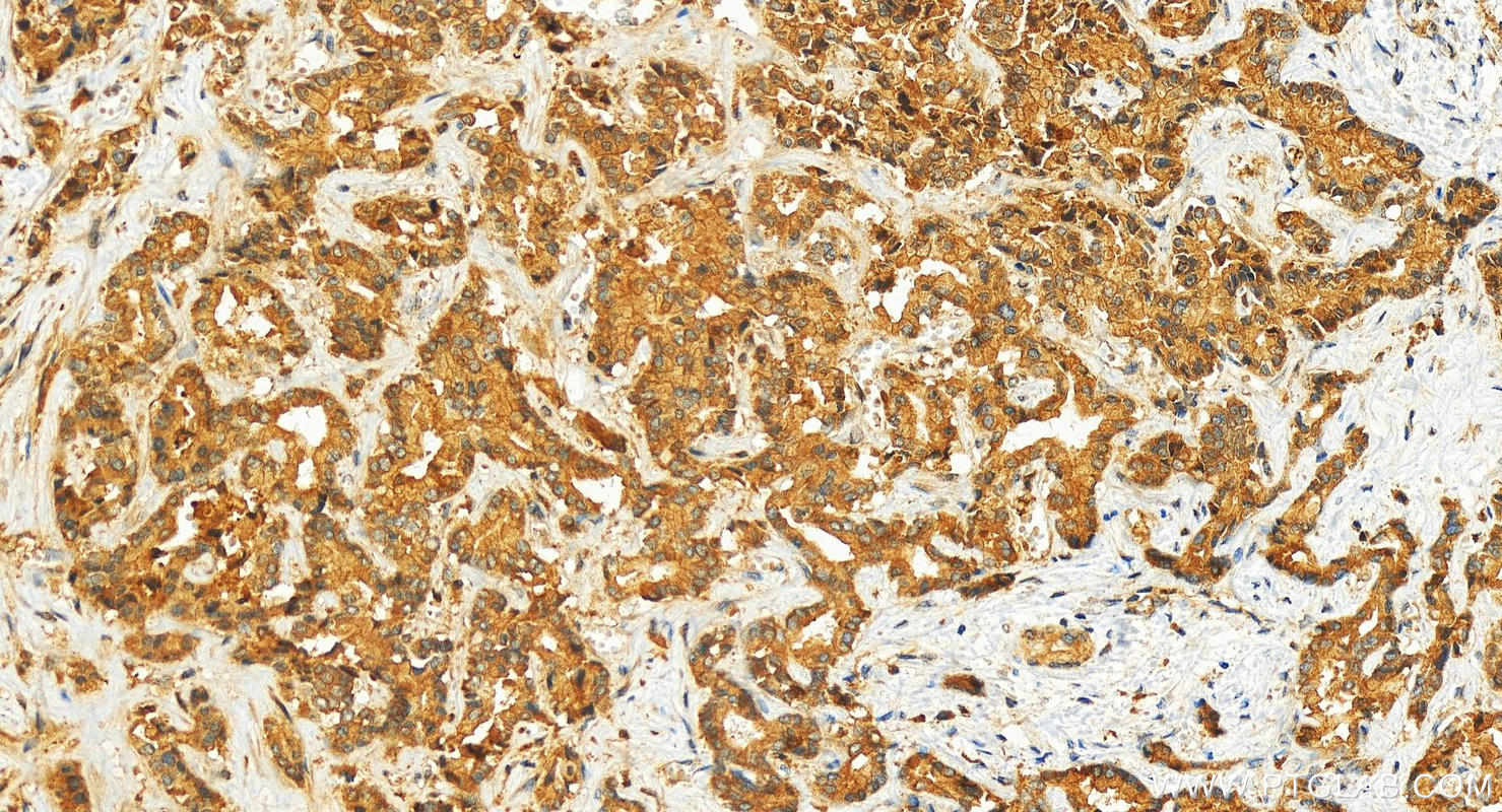 Immunohistochemistry (IHC) staining of human intrahepatic cholangiocarcinoma tissue using Cystatin A Polyclonal antibody (15962-1-AP)