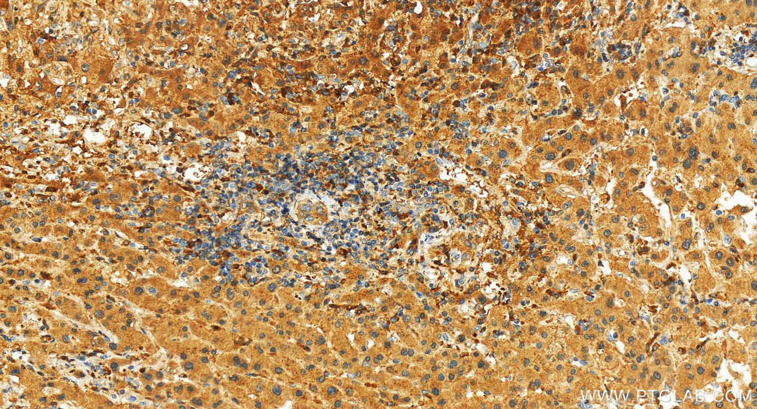 Immunohistochemistry (IHC) staining of human intrahepatic cholangiocarcinoma tissue using Cystatin A Polyclonal antibody (15962-1-AP)