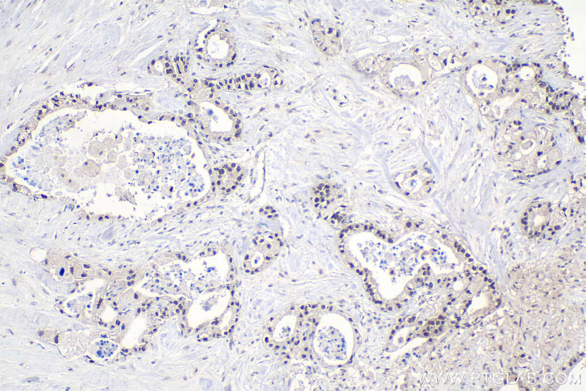 Immunohistochemistry (IHC) staining of human pancreas cancer tissue using CTBP2 Polyclonal antibody (10346-1-AP)